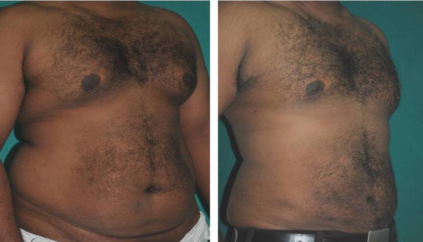 Mega liposuction in Kerala result 